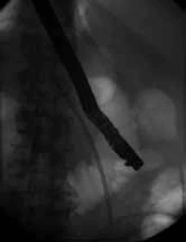 ERCP – drenáž žlučových cest perforující duodenum.
Fig. 1. ERCP – drainage of the bile ducts perforating the duodenum.