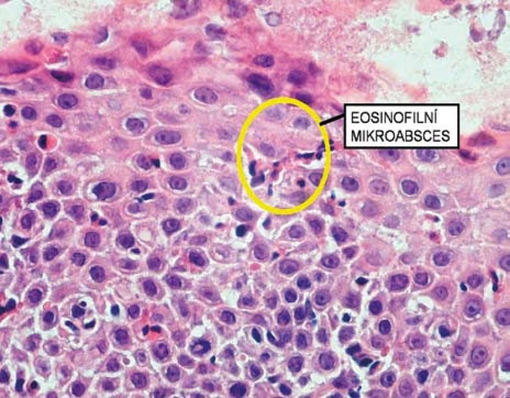 Histologický obraz eozinofilního mikroabscesu.
Fig. 7. Histological image of eosinophilic microabscess.