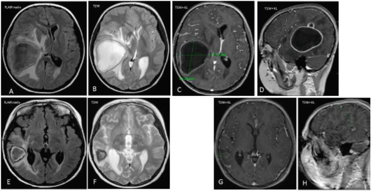 MRI mozgu pred a po liečbe u pacienta č. 1.
A–H. Na MRI zázname sa v axiálnej rovine v sekvencii FLAIR a T2W vážení znázorňuje veľká abscesová dutina s priemerom 65 x 50 mm, presun stredovej čiary a známky intrakraniálnej hypertenzie.
G–H. Diskrétne zmeny v mieste pôvodného abscesového ložiska.
Fig. 1. MRI of the brain before and after treatment in a case 1.
A–H. Axial T2-weighted MRI demonstrate the mass abscess in diameter 65 x 50 mm, and the signs of intracranial hypertension.
G–H. The minimal changes in area of previous abscess.