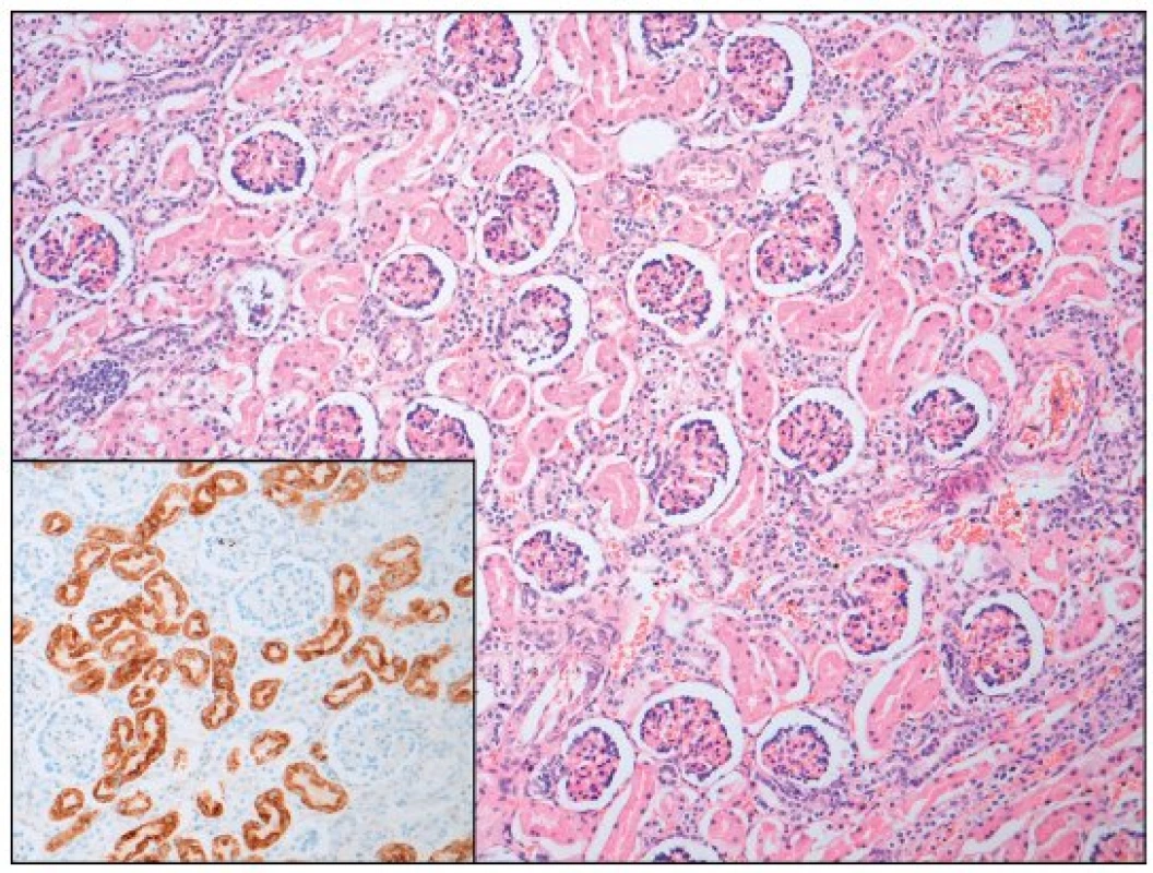 Ledvina – srovnávací preparát (hematoxylin - eosin; AMACR; zvětšení 100; počet proximálních tubulů 60/mm<sup>2</sup>).
Fig. 2. Kidney – normal (hematoxyline - eosine and AMACR; magnification 100; proximal tubules count 60 per mm<sup>2</sup>).