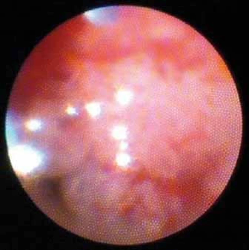 Ložisková léze. Cholangiokarcinom.
Fig. 5. Lesion. Cholangiocarcinoma.