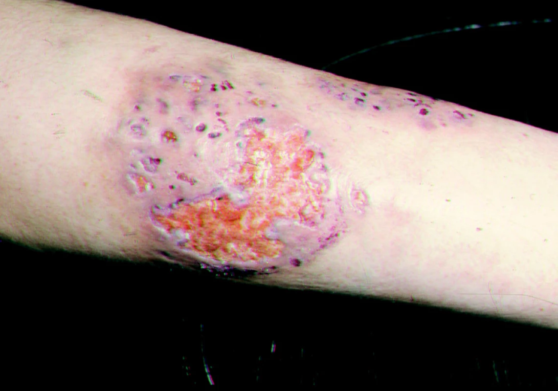 Pyoderma gangraenosum.