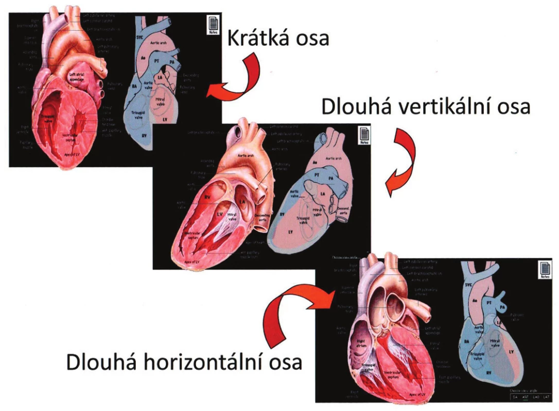Řezy myokardem LK ve třech základních rovinách.