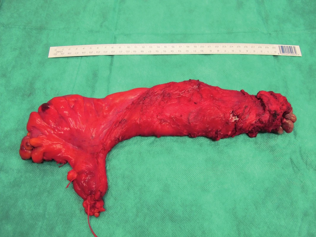 Roboticky asistovaná amputace rekta s kompletní totální mezorektální excizí (TME) – fotografie resekátu
Fig. 3. Robotic assisted abdominoperineal resection for rectal cancer with complete total mesorectal excision (TME) – photography of resected specimen