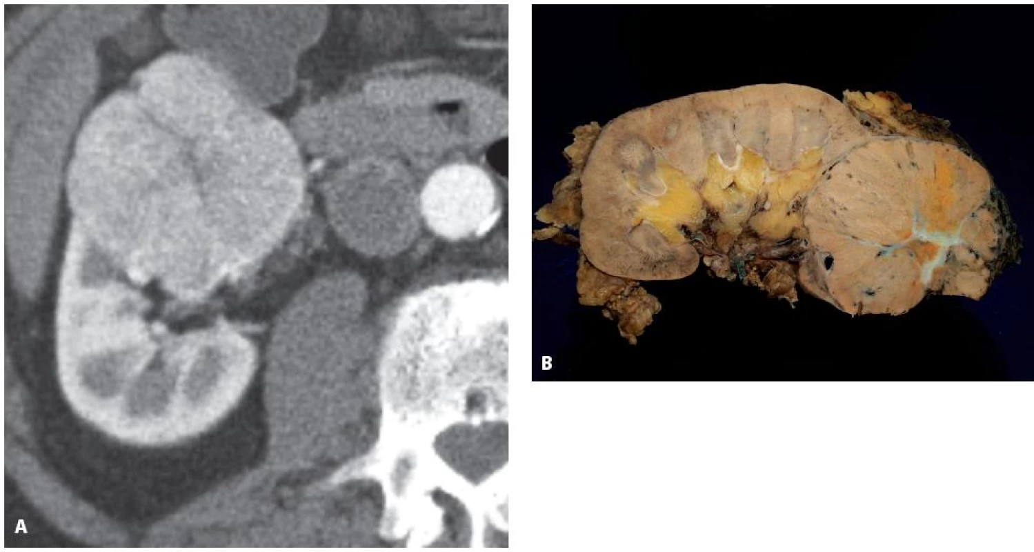 Muž 77 let, tumor dolního pólu pravé ledviny, histologicky sporadický hybridní onkocytický chromofobní tumor 
Fig. 8. Seventy seven year old male with a tumour of the lower pole of the left kidney T1bN0M0, histology hybrid oncocytic chromophobe tumour