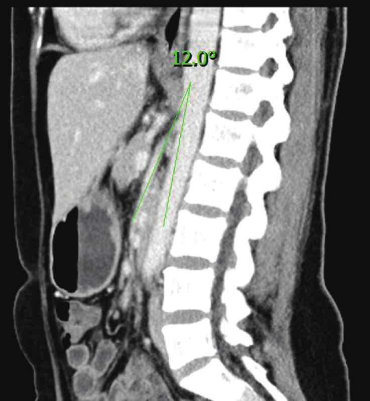 V sagitální rovině CT vyšetření je zobrazena komprese duodena mezi abdominální aortou a horní mezenterickou tepnou, přičemž odstupový úhel je 12°
Fig. 1: Sagittal reconstruction of CT images showing that the angle between the superior mesenteric artery and the aorta is narrowed to 12°