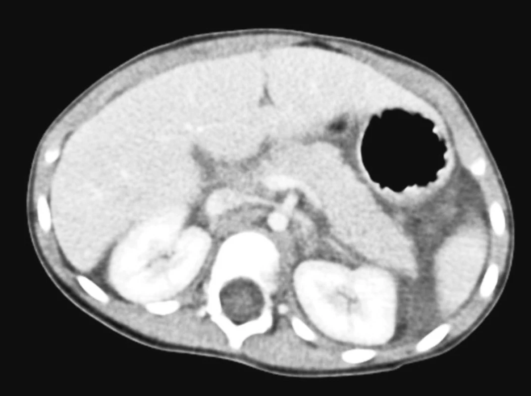CT obraz – pankreas s diskrétním otokem v okolí, pankreatický vývod nepoškozen
Fig. 5. CT view – a pancreas with a discreet swelling in the surrounding area, the pancreatic duct is intact