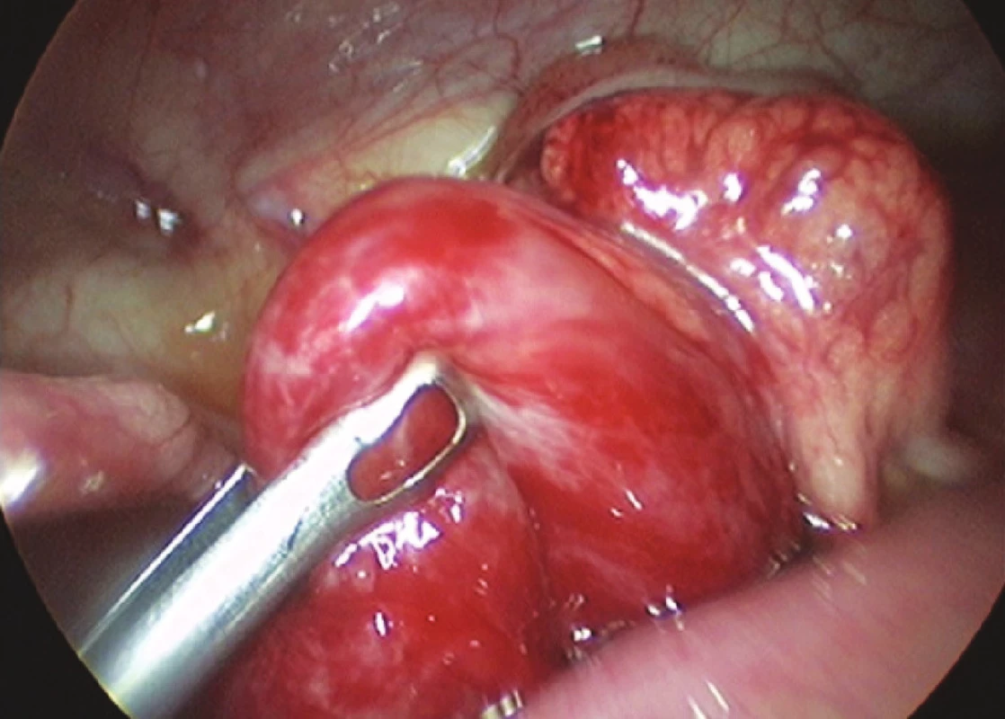 Laparoskopická dezinvaginácia pomocou atraumatického graspera (foto: V. Cingel)
Fig. 2. Laparoscopic desinvagination using an atraumatic grasper (photo: V. Cingel)
