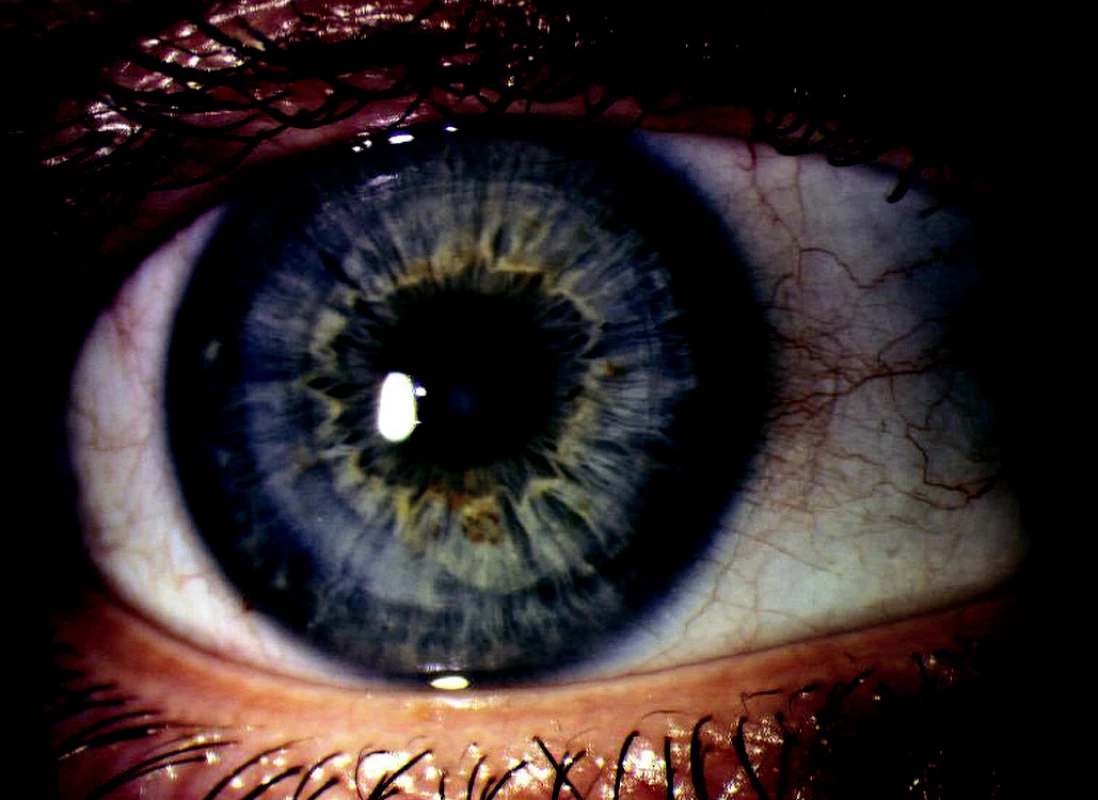 Stp. LASIK po perforující keratoplastice - 3 měsíce.