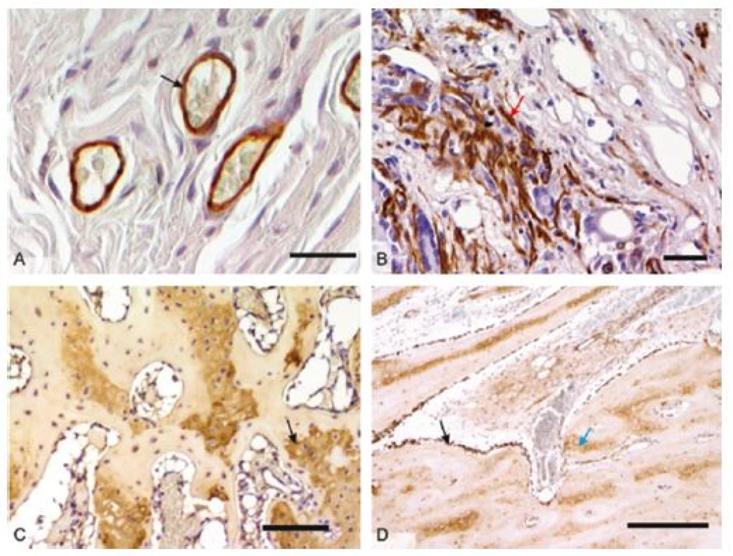 Mikrofotografie imunohistochemických preparátů orgánů z <i>in vivo</i> hodnocení biomateriálů: 2A – průkaz endoteliálních buněk (černá šipka) při testování sítěk pro prevenci vzniku hiátové hernie v břišní stěně prasete, detekce pomocí protilátky anti-CD31, měřítko 50 μm; 2B – kontraktilní myofibroblasty (červená šipka) v břišní stěně prasete, detekce pomocí protilátky proti hladkosvalovému aktinu, měřítko 100 μm; 2C – průkaz kolagenu typu II v hyalinní chrupavce (černá šipka) diferencující se v osteochondrálním defektu kondylu femuru králíka, detekce pomocí protilátky proti-kolagenu II, měřítko 100 μm; 2D – průkaz kostního proteinu osteokalcinu v osteoblastech (černá šipka) a kostní matrix (modrá šipka) v osteochondrálním defektu u králíka, detekce pomocí protilátky anti-osteokalcin, měřítko 50 μm. U všech snímků vizualizace pomocí peroxidázové reakce a diaminobenzidinu, kontrabarvení jader Gillovým hematoxylinem.