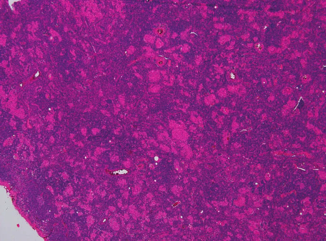 Granulomatózní proces v lymfatické uzlině
Fig. 3: Granulomatous process in a lymph node