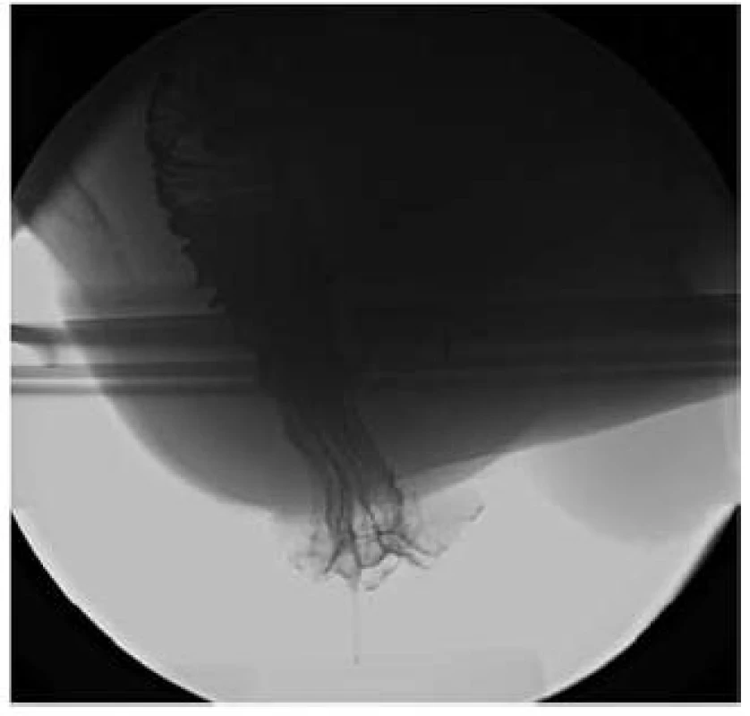 Malý externí prolaps rekta při dg. solitárního rektálního vředu.
Fig. 3. A small overting rectal prolaps due to solitary rectal ulcer syndrom.