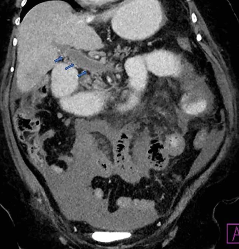 Trombóza VMS a VP   Fig. 2: SMV and PV thrombosis