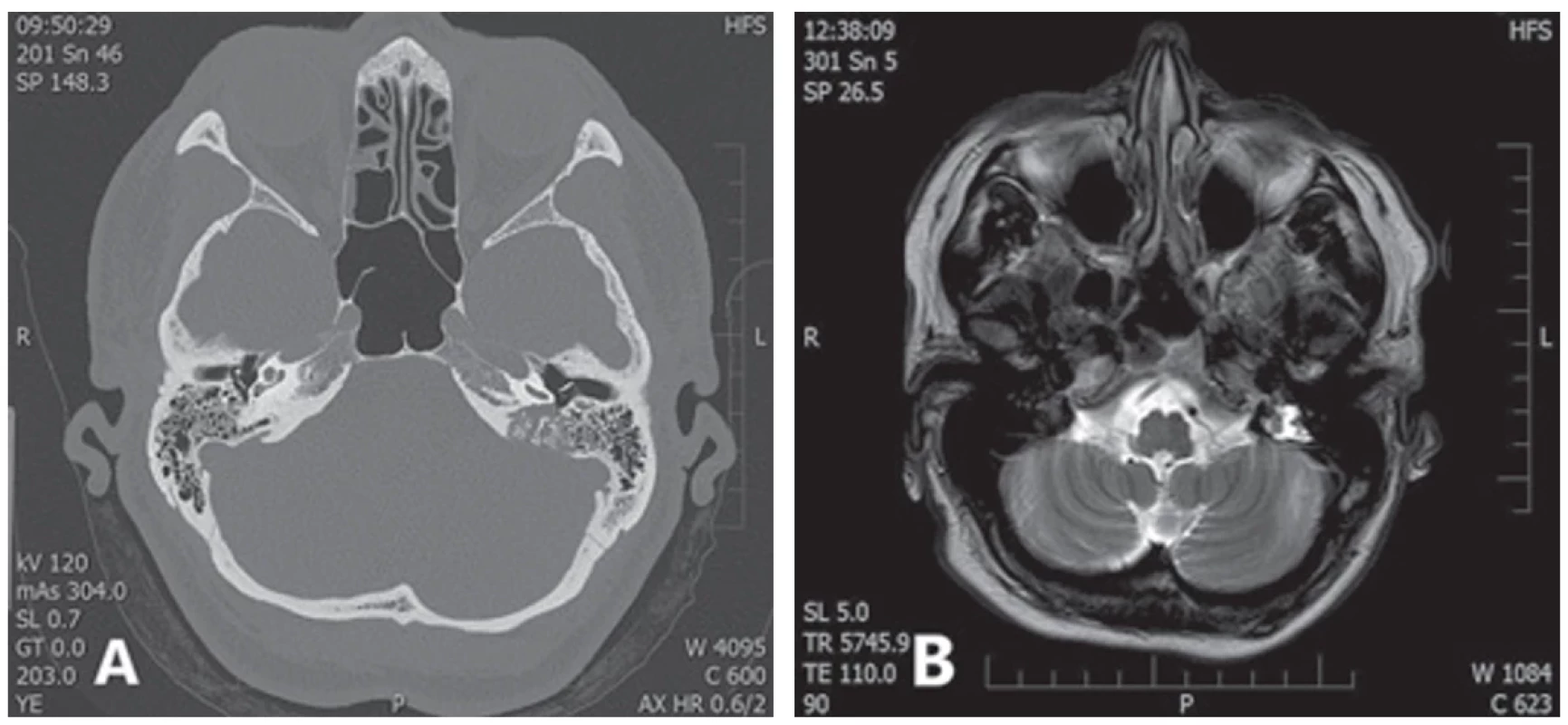Příklad nálezu karcinomu endolymfatického vaku v zobrazovacích metodách:  A) HRCT pyramid (pacient 2): retrolabyrintálně lokalizovaný tumor levé pyramidy se šířením do foramen jugulare;  B) MR mozku, T2 vážená sekvence (pacient 2): retrolabyrintálně lokalizovaný tumor se smíšeným hypo- a hyperintenzním  signálem v oblasti levé pyramidy