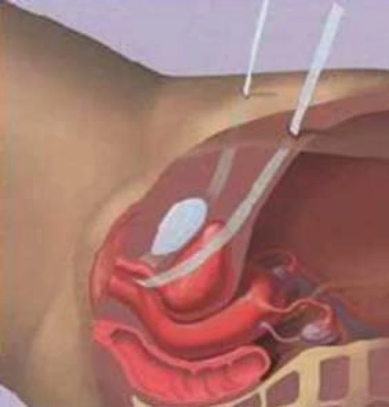 Komprese uretry při zvýšení intraabdominálního tlaku.
