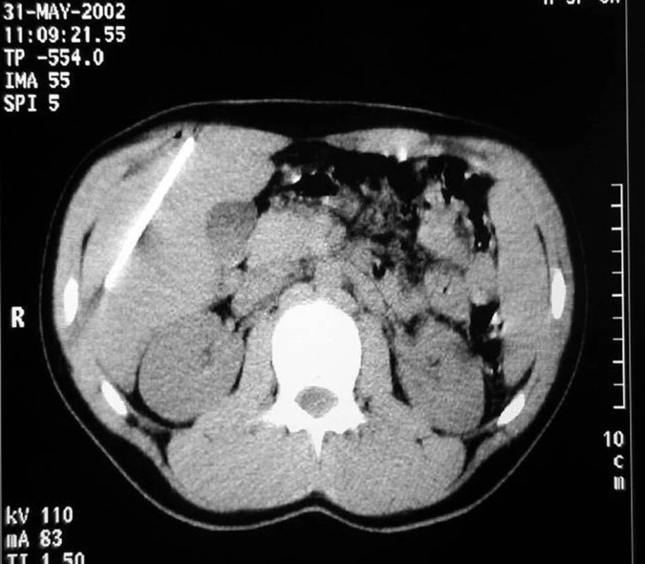 Na CT viditelné cizí těleso (střep) v pravém jaterním laloku
Fig. 2: CT, visible foreign object (glass fragment) in the right liver lobe