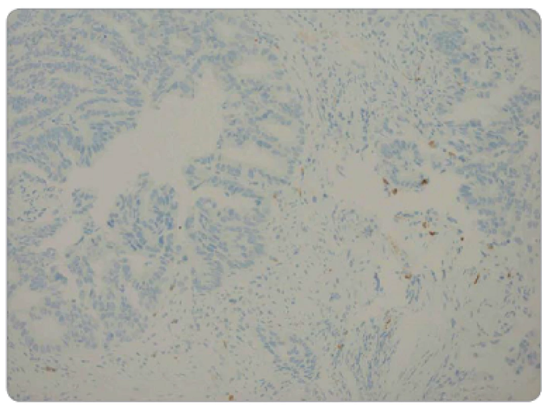 Nízká hustota CD8<sup>+</sup> TIL v předléčebné endobiopsii, imunohistochemická pozitivita CD8, zvětšeno 200x.