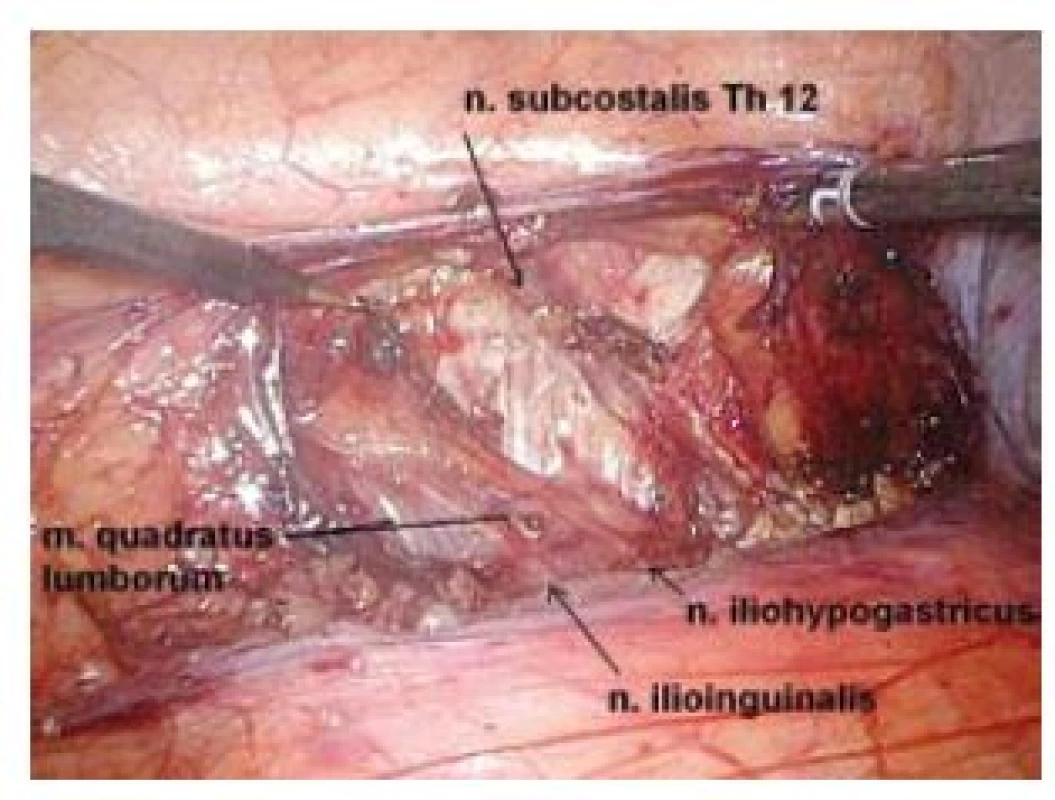 Zadní peritoneum otevřené v Toldtově linii laterálně od pravé ledviny, lze diferencovat nervy patrné na obrázku 1
Fig. 2. Peritoneum is incised laterally from the right kidney in Toldt’s line. The nerves showed on figure 1 are clearly visible.