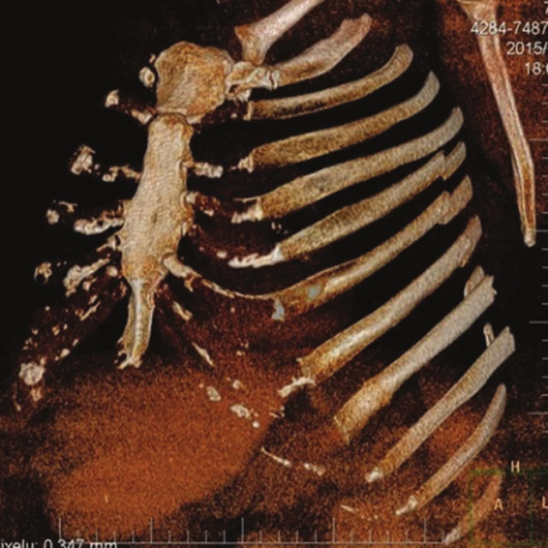 3D rekonstrukce
Fig. 8: 3D CT reconstruction