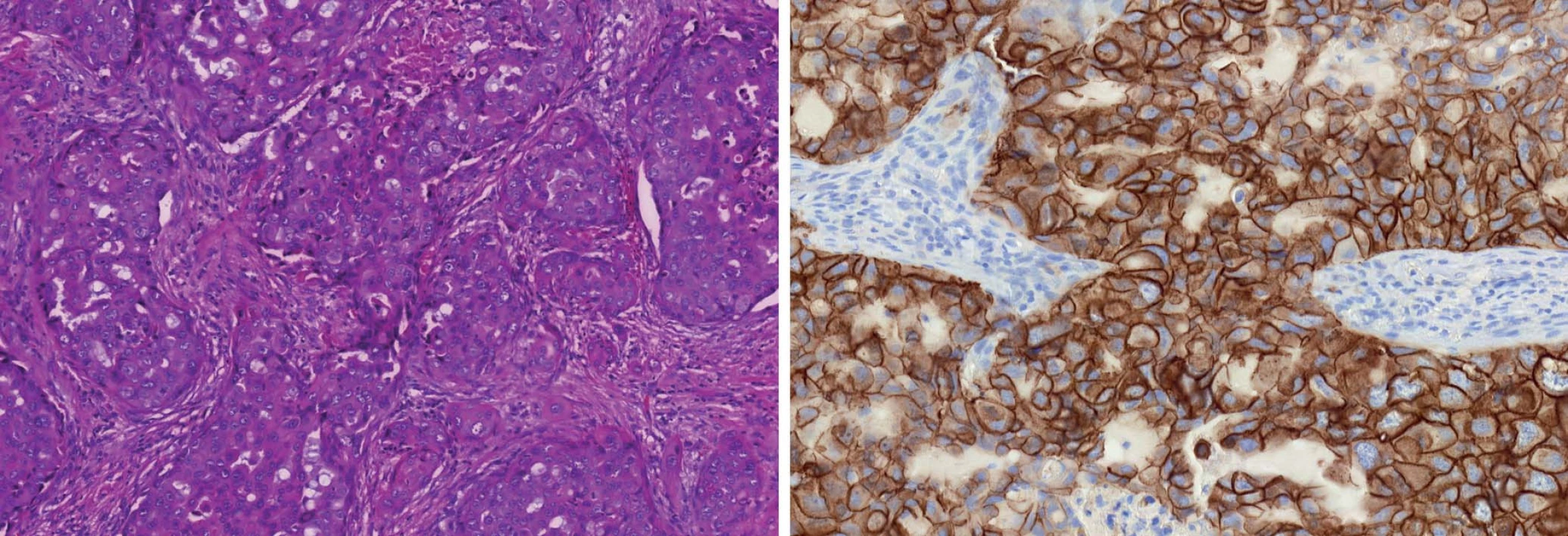 Grade 3 duktální karcinom (A). HER2/neu pozitivní profil charakterizuje overexprese a amplifikace genu HER2/neu bez ohledu na prezenci či absenci hormonálních receptorů (B).