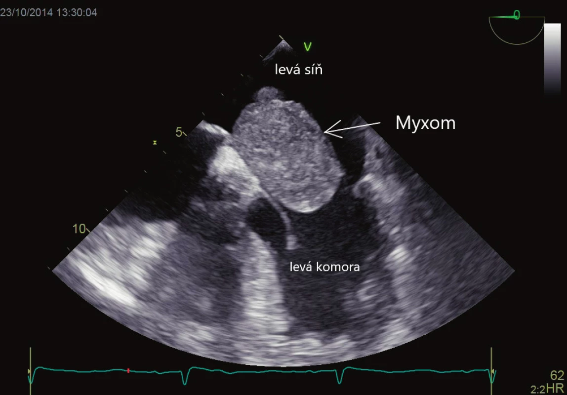 Myxom vycházející z mezisíňového septa, propadající se do ústí mitrální chlopně. Vyšetření jícnovou echokardiografií