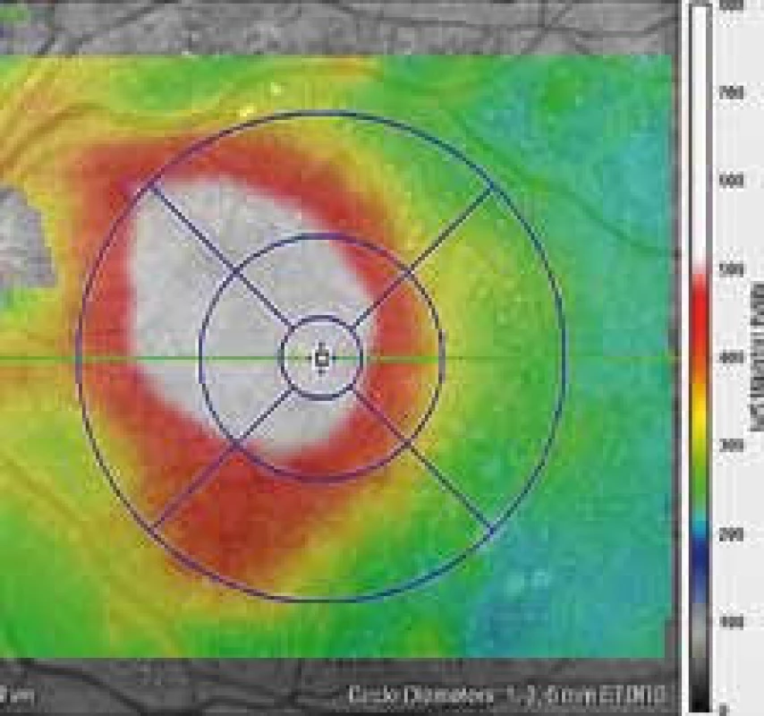 Barevná mapa makulární krajiny téhož oka stanovující výšku makulárního edému.