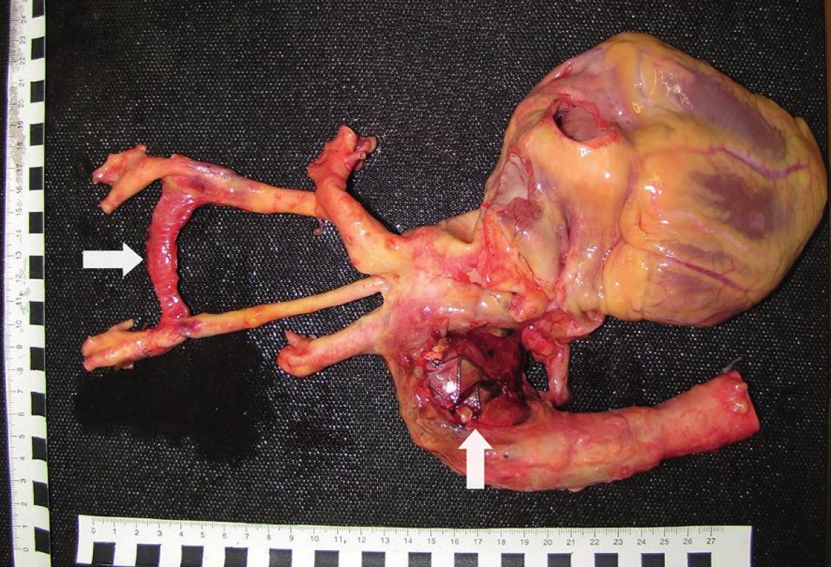 Srdce, aorta a jej hlavné odstupy pri pohľade zozadu. Prítomný defekt descendentnej aorty 
s presvitajúcim aortálnym stentgraftom (zvislá šípka) a karotickokarotickým bypassom (vodorovná šípka).