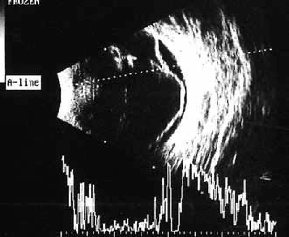 Pacient č. 2: Ultrasonografie oka pravého: hemoftalmus, hyperechogenní linie odpovídající trakčnímu odchlípení sítnice.