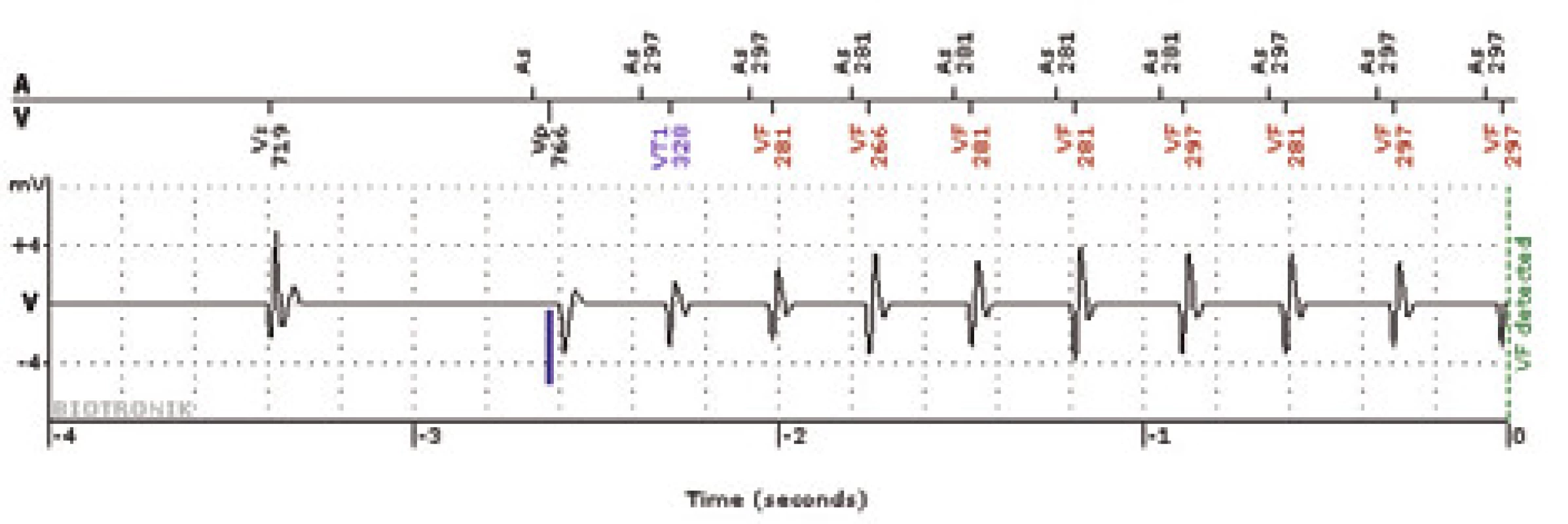 Intrakardiální elektrogram epizody detekce v zóně VF přenesené systémem Biotronik Home Monitoring<sup>TM</sup>.