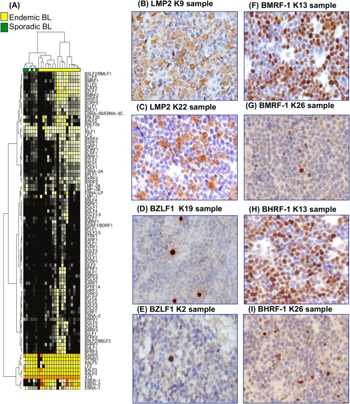(A) Unsupervised hierarchical clustering of expressed EBV genes demonstrates a diversity of non-canonical latency-associated gene expression programs with a subset of viral episome initiating lytic reactivation as indicated by expression of genes corresponding to the lytic program. (B) LMP-2A is expressed by 40 to 50% of neoplastic cells. LMP-2A stain, O.M.: 40x; (C) LMP-2A expression is identified in a proportion of neoplastic cells ranging from 20 to 30%. LMP-2A stain, O.M.: 40x; (D) BZLF1/ZEBRA positivity is expressed by 5 to 10% of neoplastic cells. BZLF1/ZEBRA stain, O.M.: 40x; (E) BZLF1/ZEBRA expression is detected in few neoplastic cells. BZLF1/ZEBRA stain, O.M.: 40x; (F) BMRF-1/Ea-D expression is observed in 50% of neoplastic cells. BMRF-1/Ea-D stain, O.M.: 40x; (G) BMRF-1/Ea-D protein expression in 5% to 10% of neoplastic cells is shown. BMRF-1/Ea-D stain, O.M.: 40x; (H) BHRF-1/Ea-R staining is found in 60% of neoplastic cells. BHRF-1/Ea-R stain, O.M.: 40x; (I) BHRF-1/Ea-R is expressed in 10% of neoplastic cells. BHRF-1/Ea-R stain, O.M.: 40x.