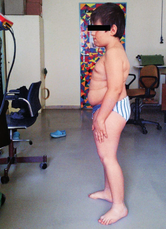 Pacient s osteogenesis imperfecta typ IV.
Fig. 1. Patient with osteogenesis imperfecta type IV.