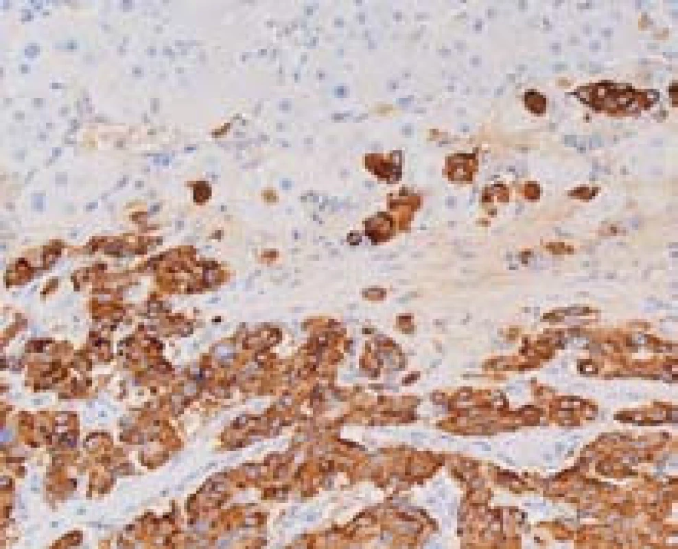 Metastáza neuroendokrinního karcinomu. Pozitivní imunohistochemický průkaz chromograninu A (hnědě) v nádorových buňkách, hepatocyty jsou negativní. Zvětšení objektiv 40×.
Fig. 7. Metastasis of neuroendocrine carcinoma with positive detection of chromogranin A (brown). Hepatocytes are negative; high power field. 