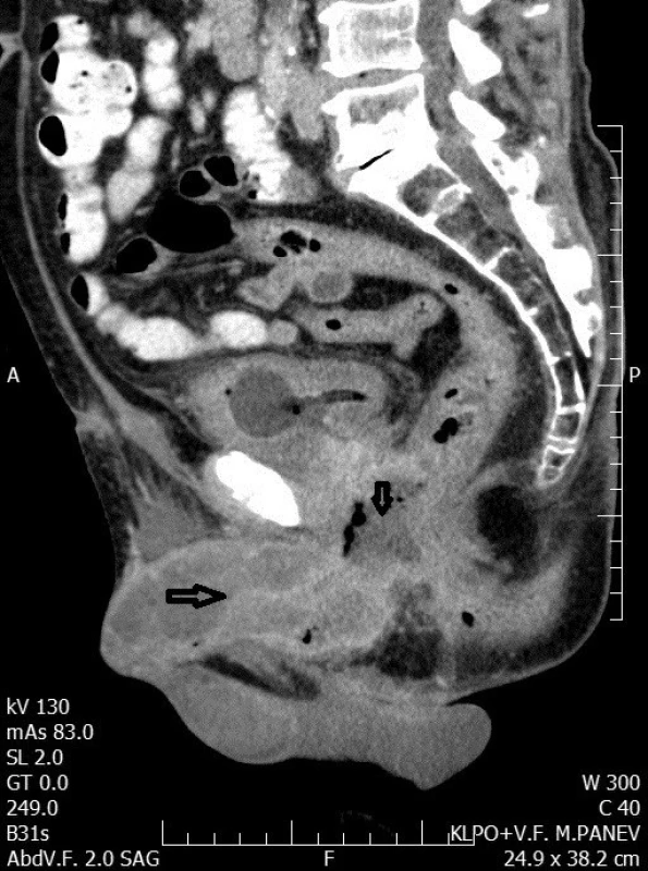 CT venózní fáze, sagitální řez: infiltrát penisu prorůstající do malé pánve a píštěl mezi prostatickou částí uretry a rektem
Fig. 1. CT scan venous phase, sagittal section: penis infiltration penetrated into the small pelvis and fistula between the prostatic urethra and rectum