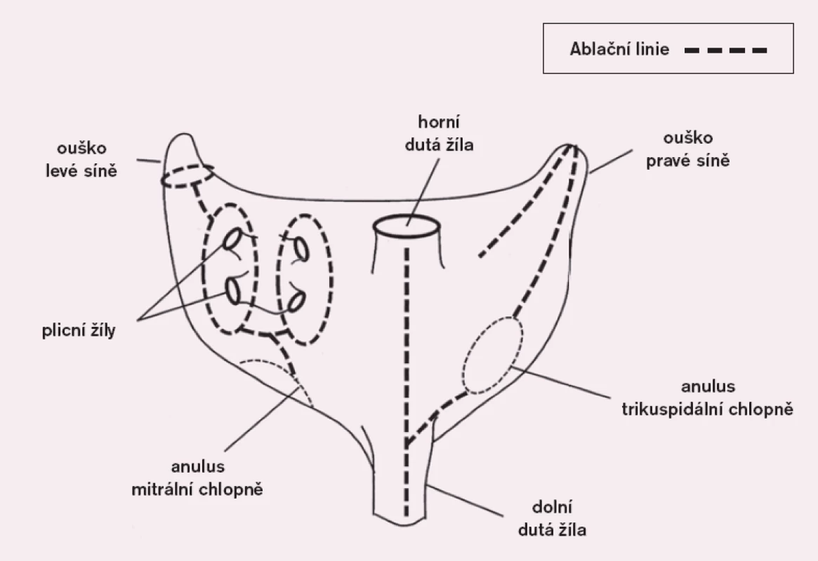 Schéma kompletních lézí na obou síních při operaci maze III (modifikováno dle Gaynor [11]).