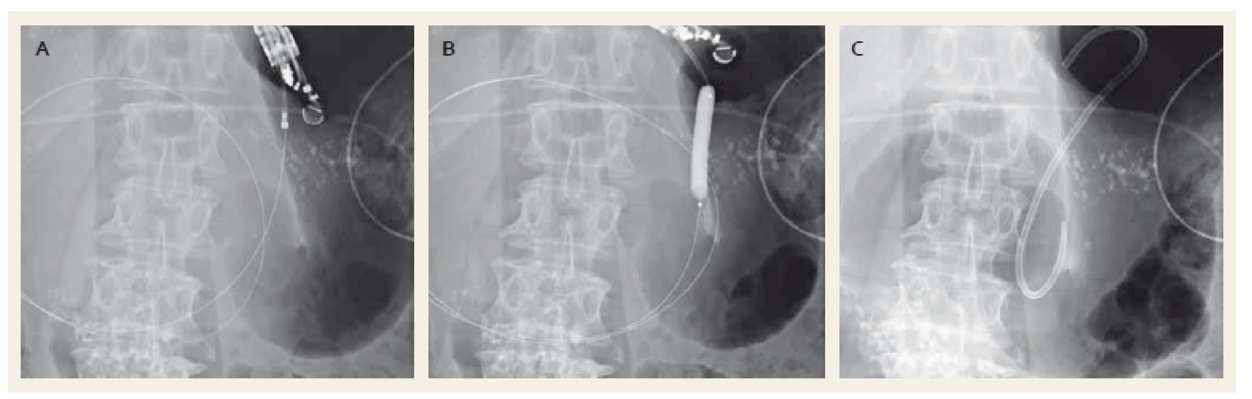 Drenáž pseudocysty plastikovým stentem. Punkce kolekce cystotomem zavedeným po vodiči (A), dilatace anastomózy balonkem (B), zavedený plastikový stent (C).
Fig. 1. Drainage of a pancreatic pseudocyst with a plastic stent. Puncture of the collection with a cystotome over a wire (A), dilation of anastomosis with a balloon (B), drainage with a plastic stent (C).