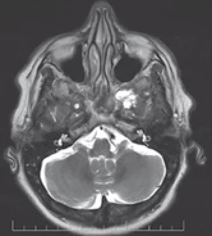 MRI of the tumor – third case.