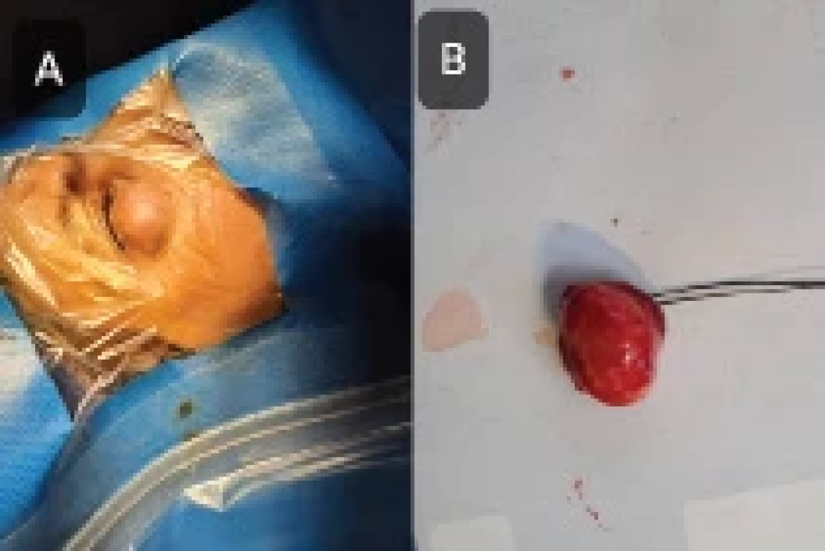 The patient’s right lower eyelid appearance immediately before the surgery (A) and the Excised lesion (B)