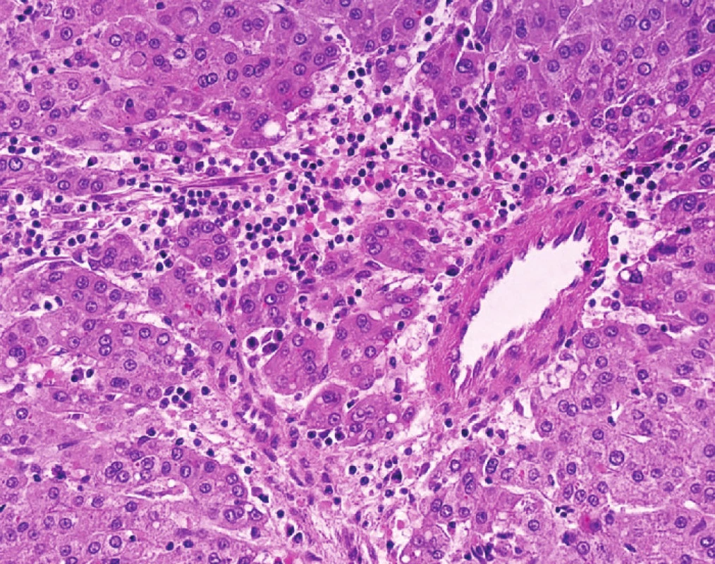 HCC s nepárovou arterií, tj. arterií samostatně ležící mimo portální pole mezi nádorovými buňkami 
Nepárové arterie jsou histologickým korelátem neovaskularizace, která představuje hlavní diagnostický znak HCC v průběhu zobrazovacích metod.
Fig. 2: HCC with unpaired artery – such arteries are small arteries occurring outside the original portal tracts (unaccompanied by bile duct) 
Unpaired arteries are indicative of neovascularization and this characteristic feature is used for the diagnosis of HCC in radiological imaging.
