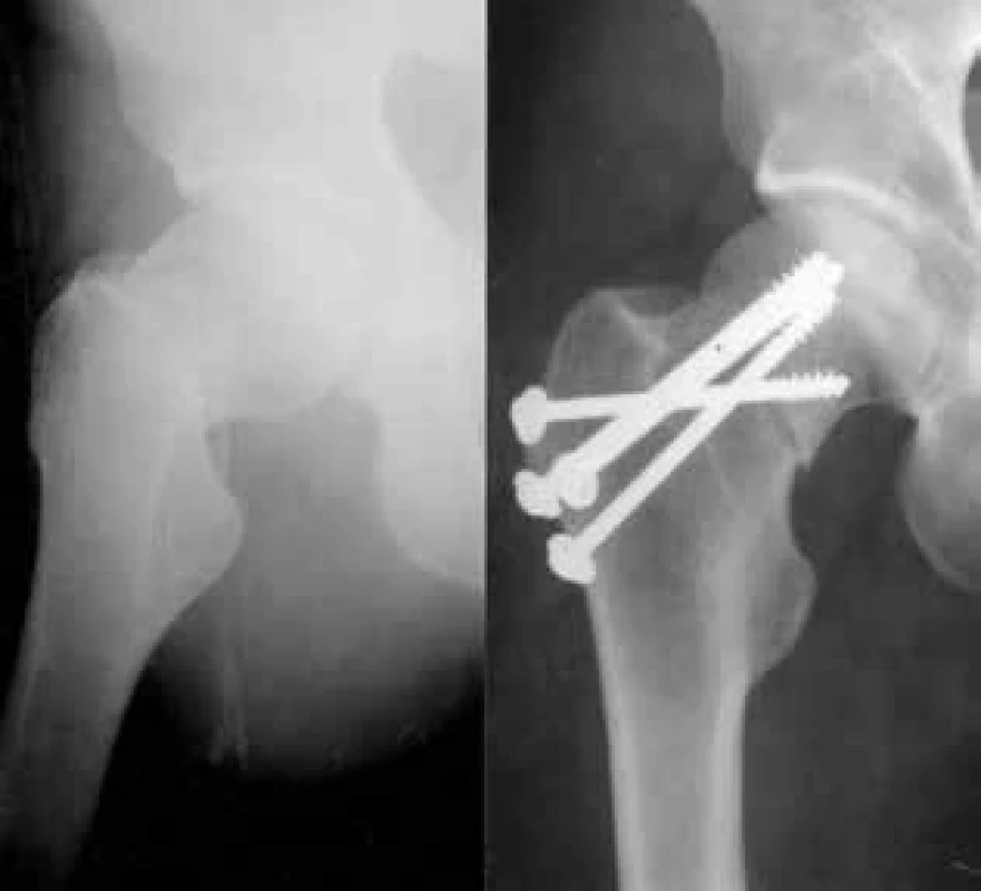 Osteosyntéza intrakapsulární zlomeniny krčku femuru tahovými spongiózními šrouby