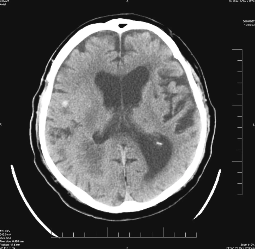 Stav po provedené biopsii – hyperdezní ložisko odpovídající hemoragii mimo oblast biopsie
Fig. 3. Post-biopsy condition – a hyperdense focus accordant to bleeding outside the biopsy region
