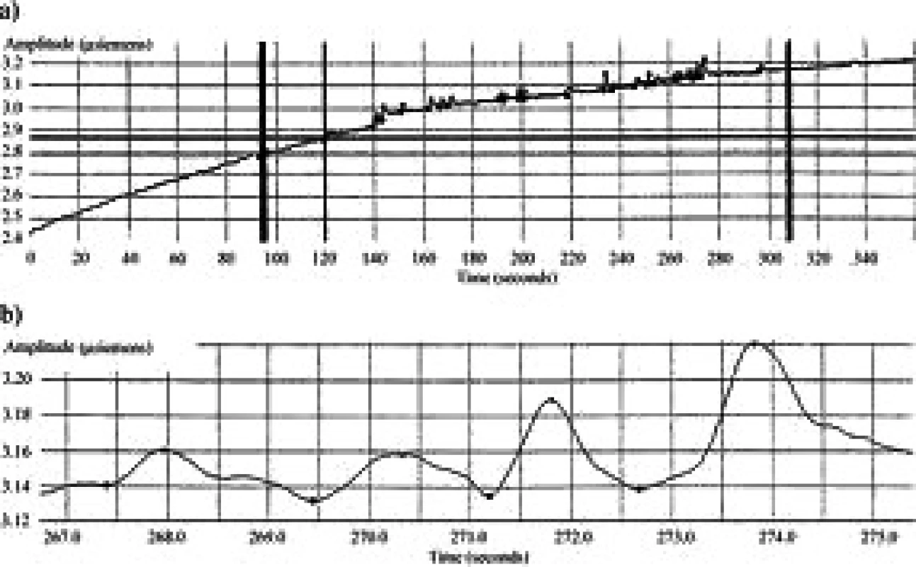 Grafické vyjádření průběhu měření parametrů ESC. 
User Manual, Med-Storm Stress DetectorTM, Med- Storm nnovation AS, Version 1.0 English (Europe), Part number 4001. Dostupné na: <http://www.medstorm.com/pdf/1342-5MA001-22%20Manual.pdf>