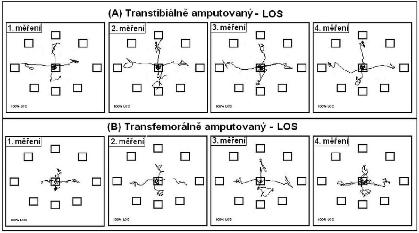 Průběh trajektorie COP během inklinace testovaným směrem u A) transtibiálně amputovaného, B) transfemorálně amputovaného.