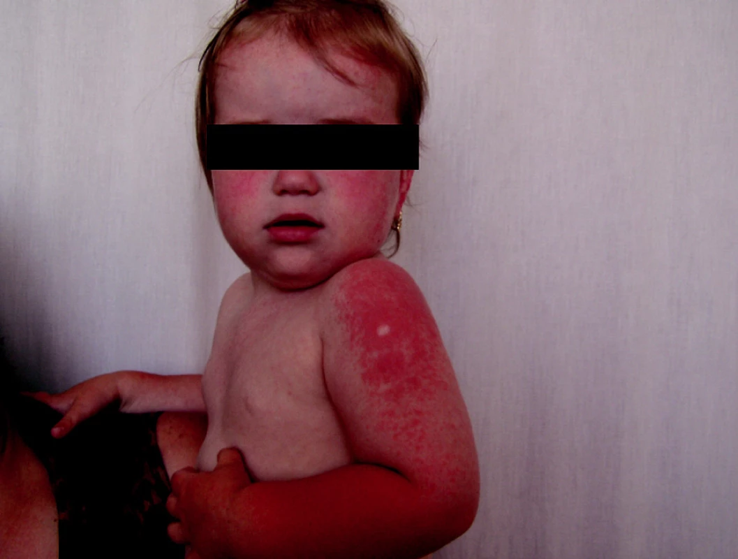 Gianotti-Crosti syndrome, 4-ročné dievča
