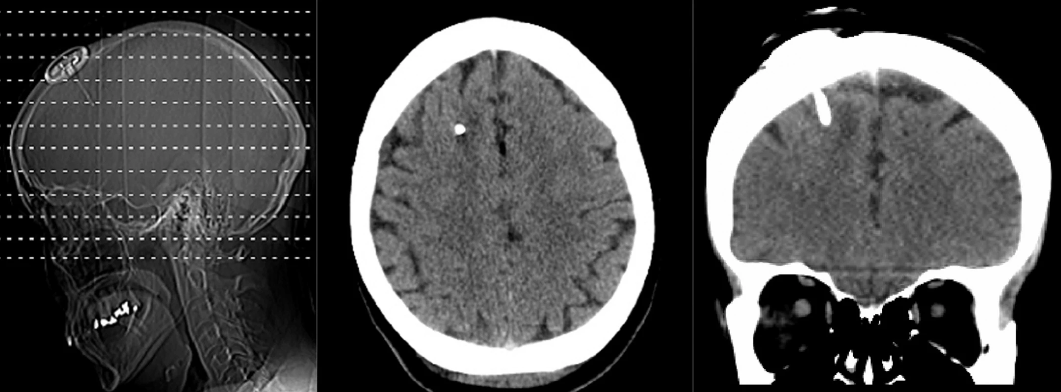 Kontrolní vyšetření výpočetní tomografií potvrzující korektní polohu ICP čidla
Fig. 2: Postoperative computed tomography confirming the correct position of the ICP sensor