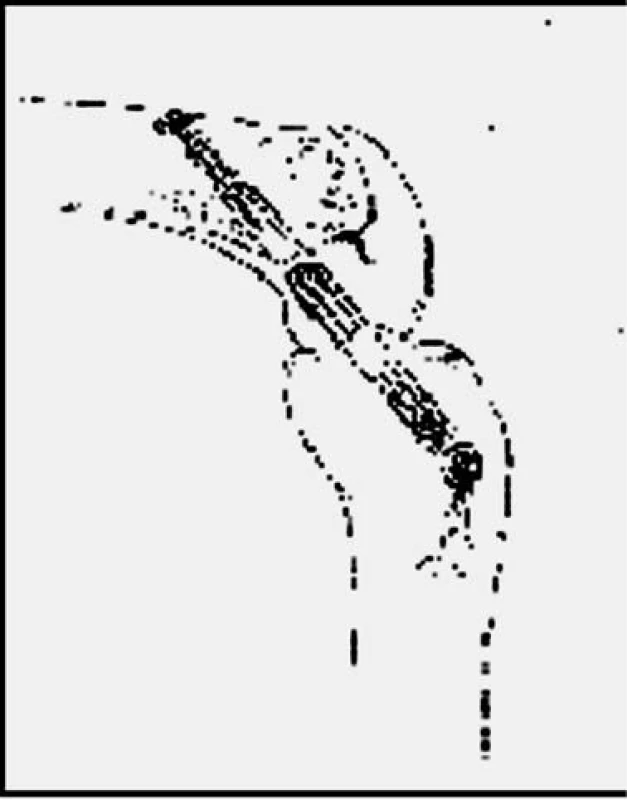 Endobutton position