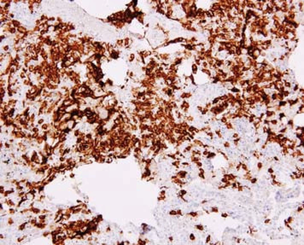 Imunohistochemická pozitivita ve vyšetření s protilátkou proti antigenu CD1a (původní zvětšení 200x).