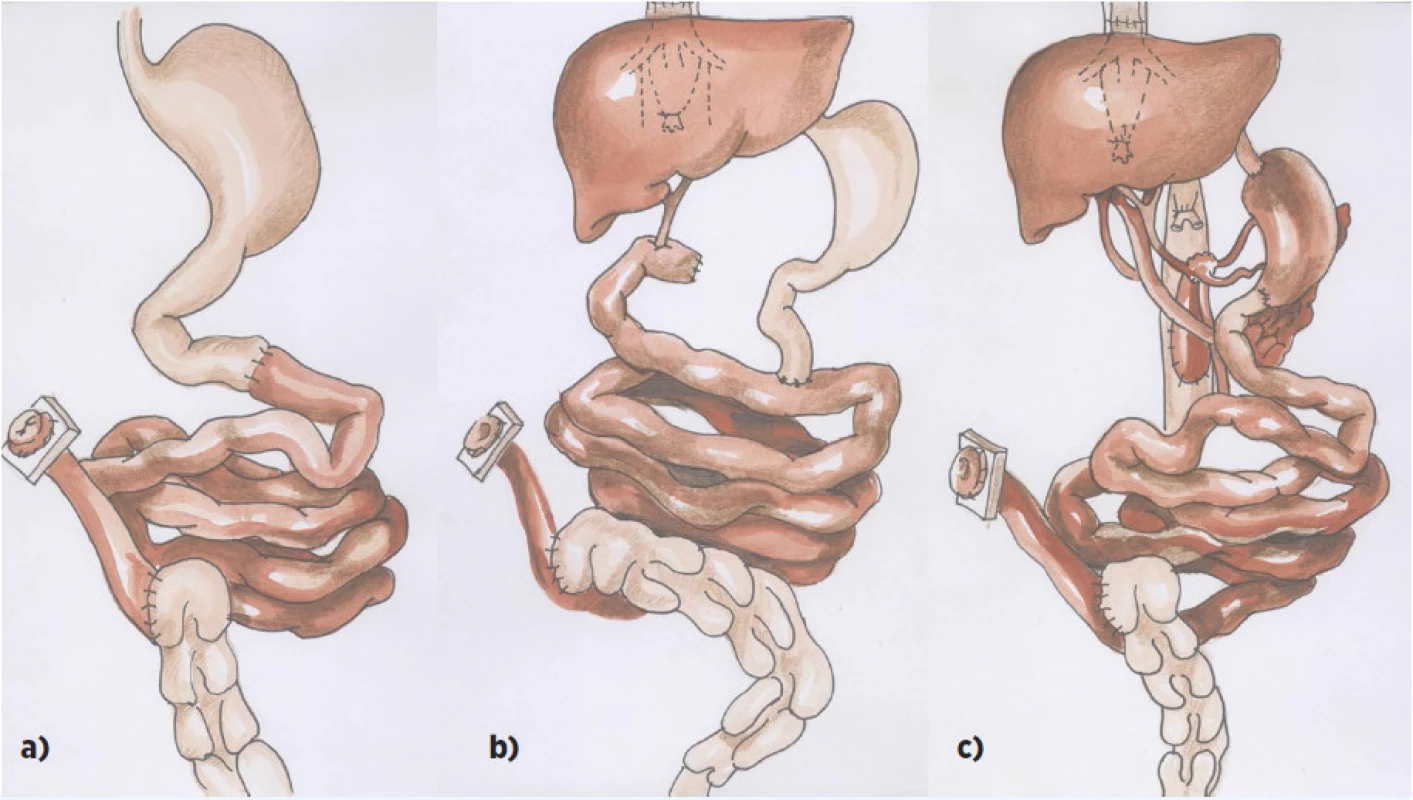 Schéma transplantace střeva:
a) izolovaná transplantace střeva
b) transplantace střeva a jater
c) multiviscerální transplantace