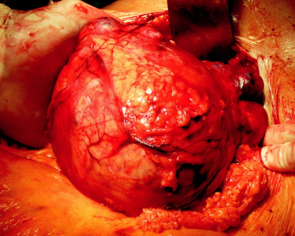 Pravostranná radikální nefrektomie
Fig. 7. Right-sided radical nephrectomy