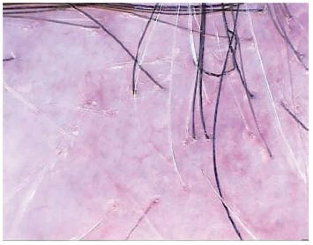 Jizvící alopecie – lichen planopilaris