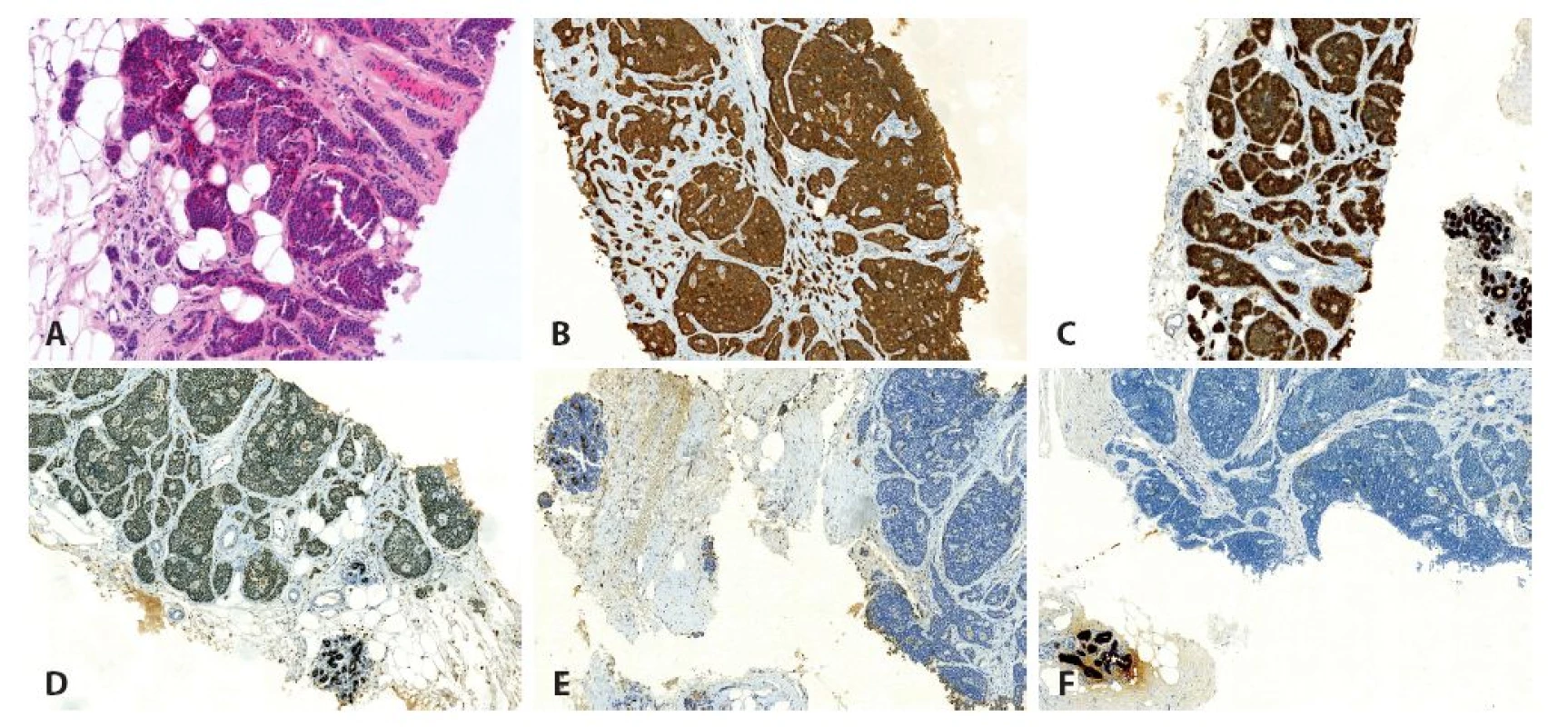 Jehlová biopsie mléčné žlázy. A: barvení HE (zvětšení 200x), B: imunohistochemický průkaz chromograninu (zvětšení 100x), C: imunohistochemický průkaz AE1/AE3 (zvětšení 100x), D: imunohistochemický průkaz ER, slabá až středně silná pozitivita v nádoru, pozitivní vnitřní kontrola v lalůčcích mléčné žlázy (zvětšení 100x), E: imunohistochemický průkaz mammaglobinu, negativní exprese v nádoru, pozitivní vnitřní kontrola v lalůčcích mléčné žlázy (zvětšení 100x), F: imunohistochemický průkaz GCDFP-15, negativní exprese v nádoru, pozitivní vnitřní kontrola v lalůčcích mléčné žlázy (zvětšení 100x).